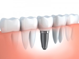 Dental Implants Changing the way