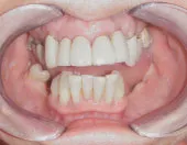 Before dental implants