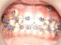 Teeth with braces and bracketed impacted teeth
