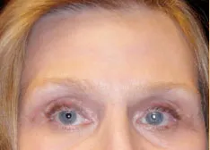 Patient after a mini brow lift and eyelid surgery