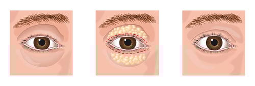 A graphic showing the eyelid surgery procedure
