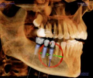 Radiograph with models of dental implants
