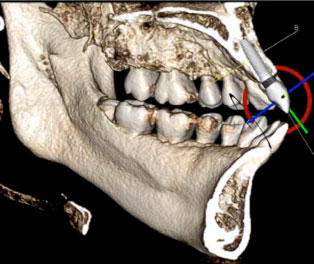 Radiograph with a model of a dental implant