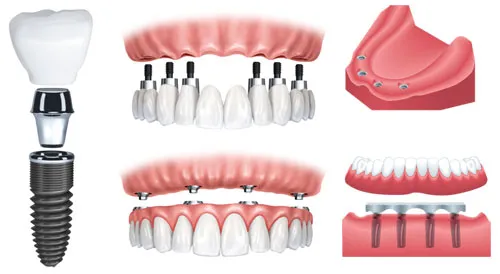 A diagram of different dental implant options
