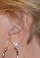 Ear of a woman who has had a facelift
