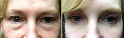 before and after photo of eyelid surgery