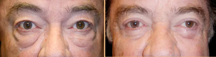 Patient before and after eyelid surgery