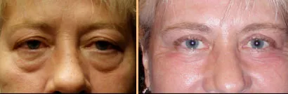 Patient before and after eyelid surgery