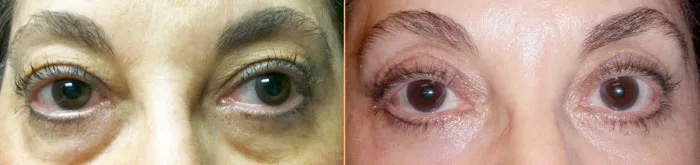 Patient before and after eyelid surgery