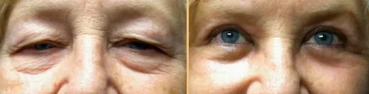 Patient before and after eyelid surgery