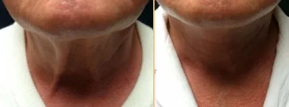 A patient's neck before and after a facelift