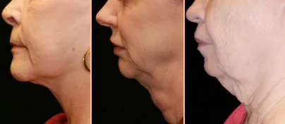 Side views of people with different amounts of sagging neck skin