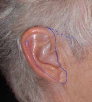 A line showing the length of the incision for a traditional facelift