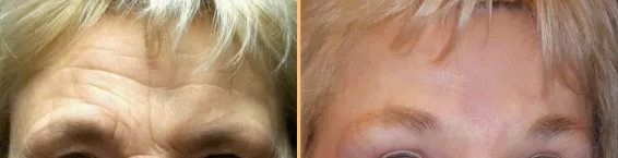 Patient's forehead before and after a forehead lift