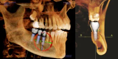 Radiographs with models of dental implants