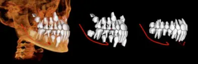 Radiograph with models of teeth