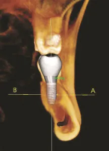 Radiograph with a model of a dental implant