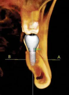 Radiograph with a model of a dental implant