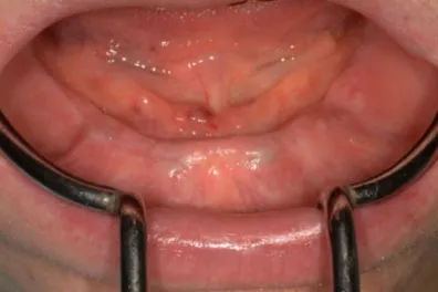 Severe resorption of the lower ridge following teeth extractions