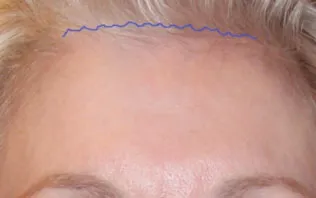Photo showing new hair growth through a previously made incision on the forehead