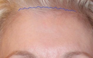 Photo showing new hair growth through a previously made incision on the forehead