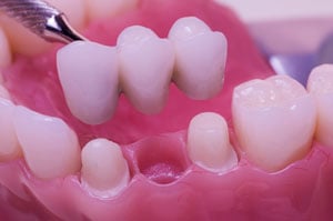 Dental implant being placed on a model of a set of teeth