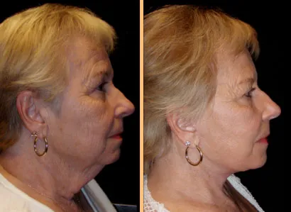 Side view of a patient before and after a facelift
