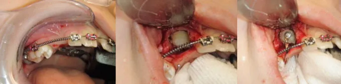 An impacted teeth getting exposed and bracketed