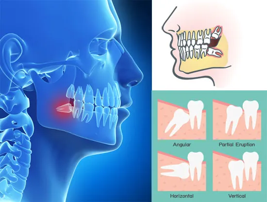 Graphic showing different types of wisdom tooth impaction