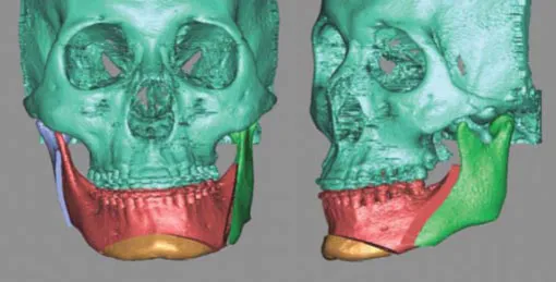 Computer-generated model showing different areas of the jaw