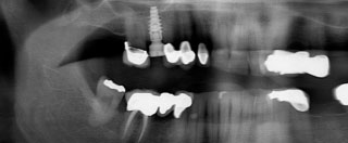 X-ray of a dental implant