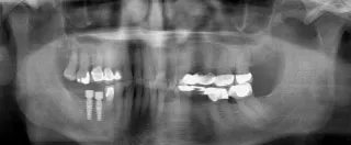 X-ray of dental implants