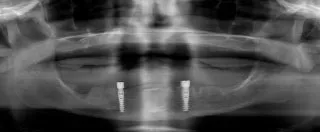 X-ray of dental implants