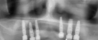 X-ray of dental implants