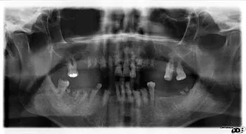 X-ray of mouth before dental implants