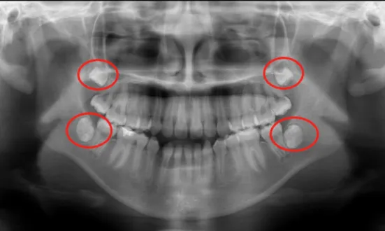 X-ray highlighting the wisdom teeth