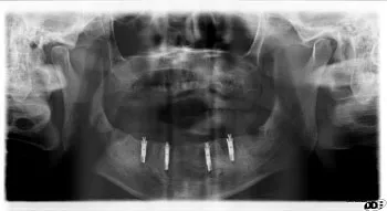 X-ray of mouth after the removal of teeth, placement of implants, & placement of the prosthesis on the same day