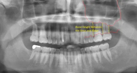 X-ray of a normal maxillary sinus