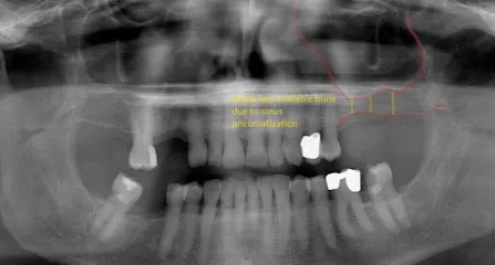 X-ray of a pneumatized maxillary sinus
