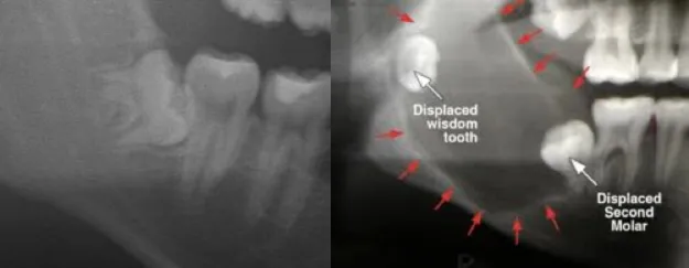 X-rays showing an impacted wisdom tooth and displaced molars