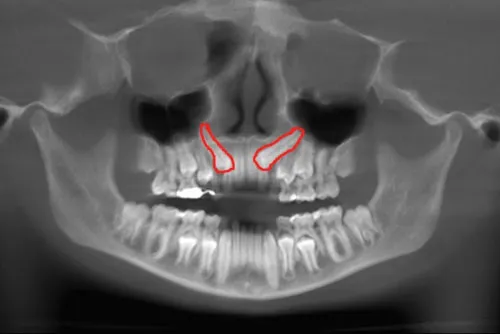 X-ray of impacted eyeteeth