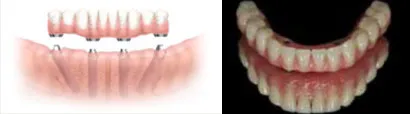 GRAPHIC AND PHOTO OF DENTURES