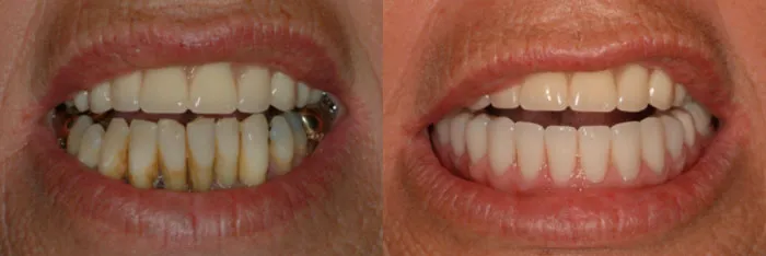 before and after teeth in an hour