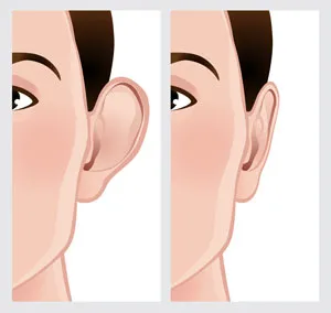 a graphic representing before and after ear surgery