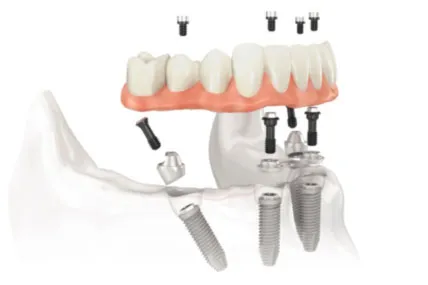 An illustration of the teeth-in-an-hour procedure