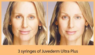 A woman before and after 3 syringes of Juvaderm Ultra Plus