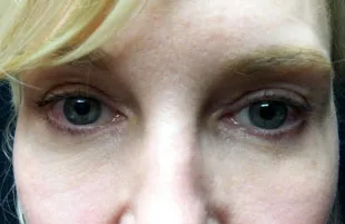 A patient after an upper and lower eyelid blepharoplasty