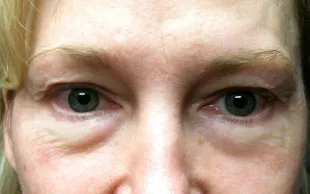 A patient before an upper and lower eyelid blepharoplasty