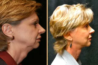 A middle-aged woman before and after facial surgery