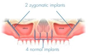 An illustration of a mandibula with zygomatic implants